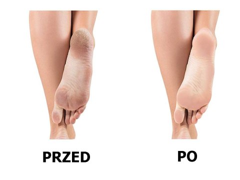 Elektryczny pilnik frezarka do pięt stóp tarka