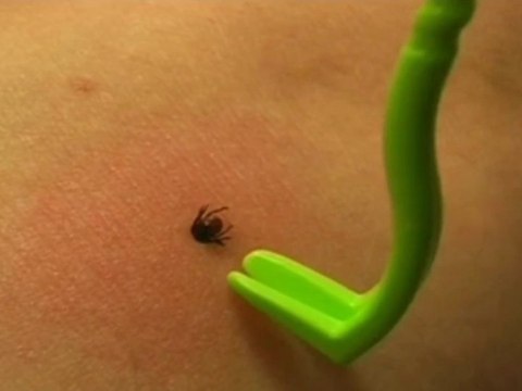 Haczyki do usuwania kleszczy pęseta łapki 2 szt